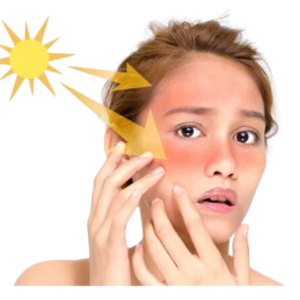 Sun Burn & Damage control